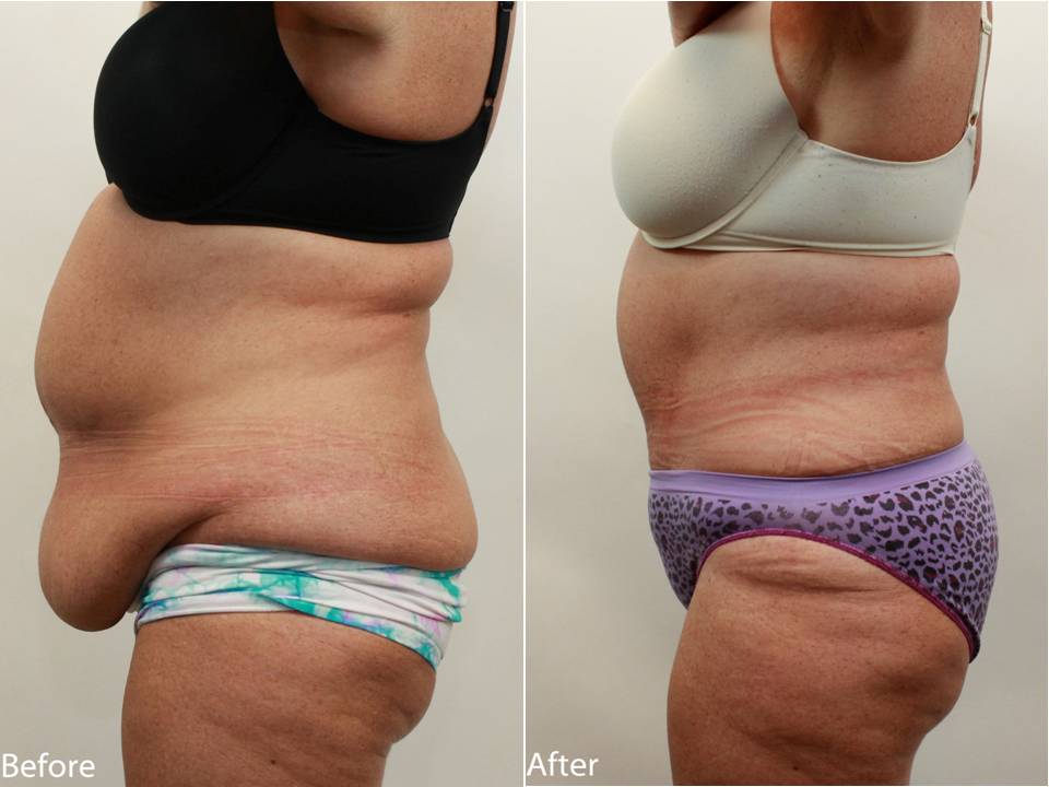 How to Lose Stomach Fat Fast Within Days UNBELIEVABLE!